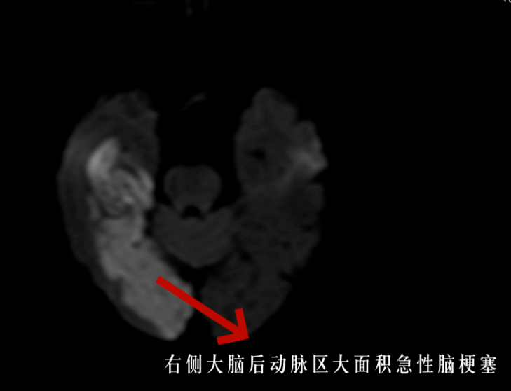 【福德内科】七旬大爷脑梗塞危急，内二团队精准救治