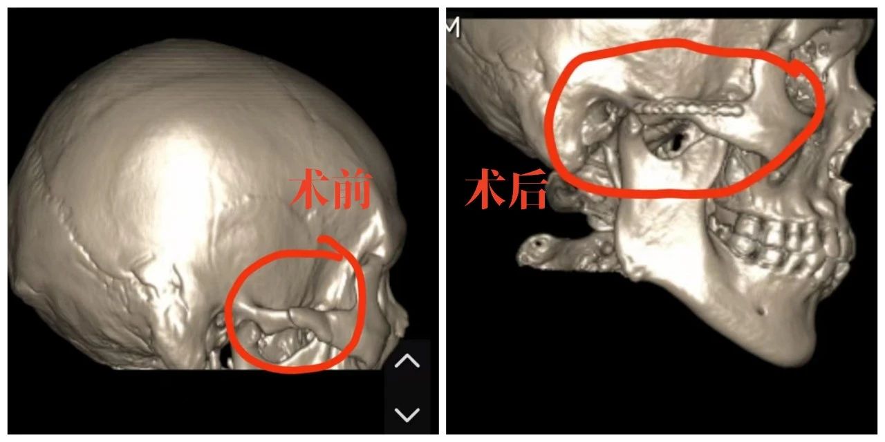【耳鼻喉科】强强联合！多学科团队微创复位颧弓骨折