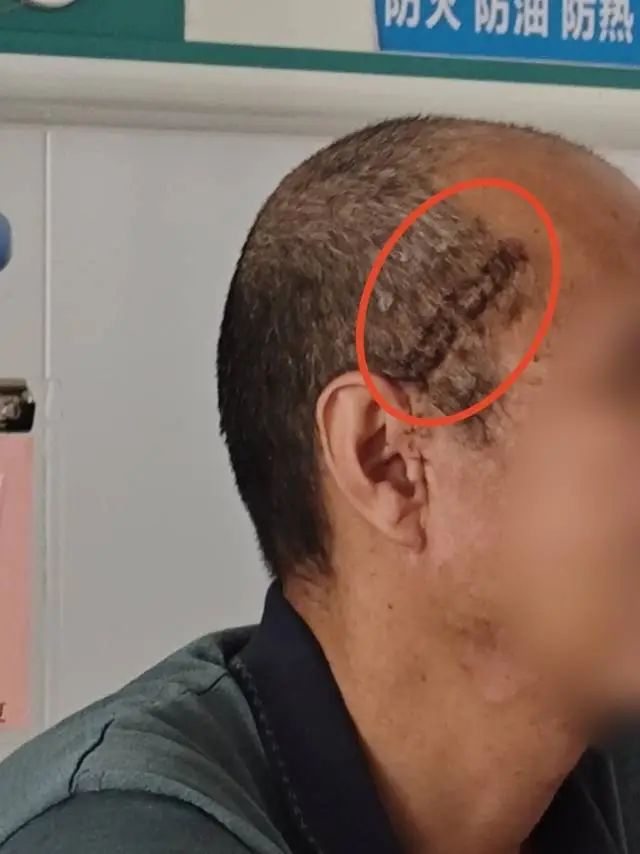 【耳鼻喉科】强强联合!多学科团队微创复位颧弓骨折