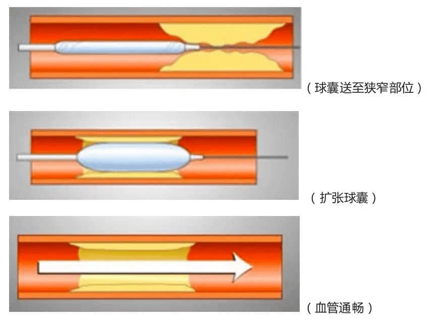 血管通路，莆田福德呵护