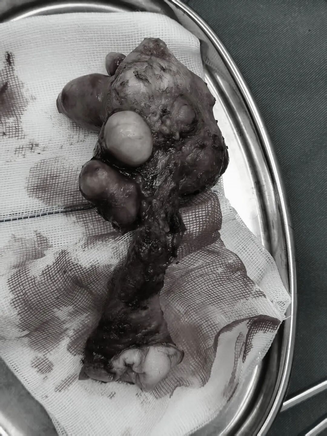 福德妇科不开刀无切口解决子宫脱垂