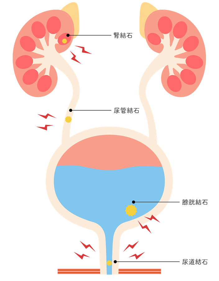 【福德泌尿】结石治疗新选择！一根“软镜”无创碎石！