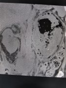 【福德泌尿】精准“拆弹”！成功救治气肿性肾盂肾炎重症感染患者！