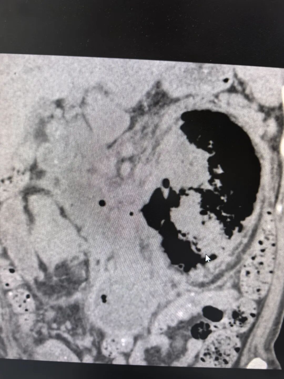 莆田福德医院泌尿肾病科成功救治气肿性肾盂肾炎重症感染患者