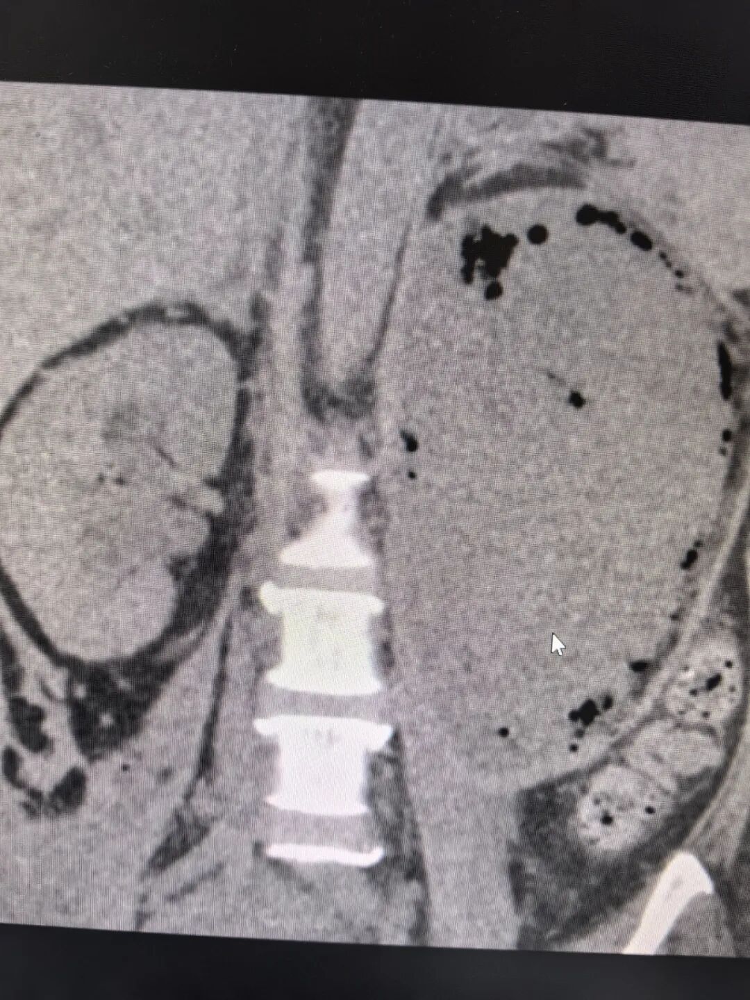 莆田福德医院泌尿肾病科成功救治气肿性肾盂肾炎重症感染患者
