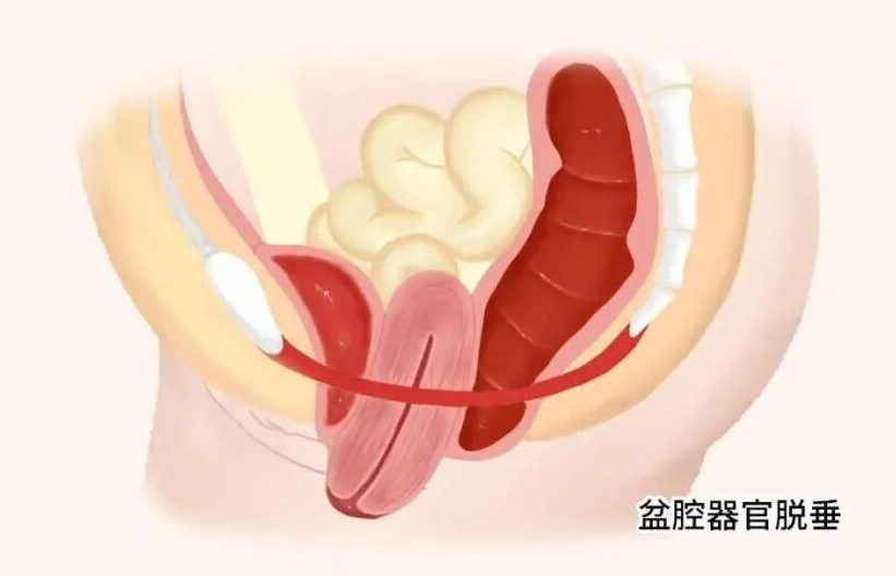 【福德康复】关注盆底健康，守护幸福“底”线