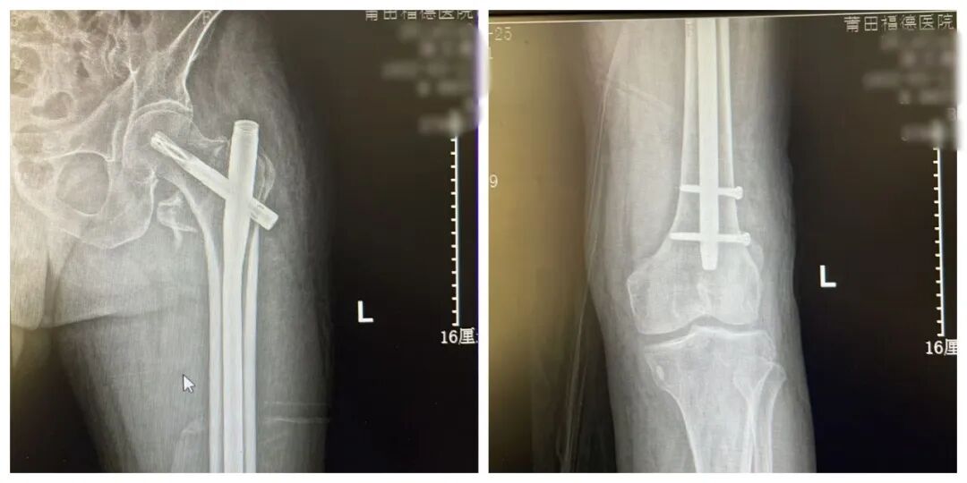 【福德骨科】微创手术攻克“人生最后一次骨折”，让高龄不再是禁区！