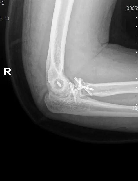 【骨科联盟】莆田福德医院黄益平主任成功实施肘关节“恐怖三联征”手术