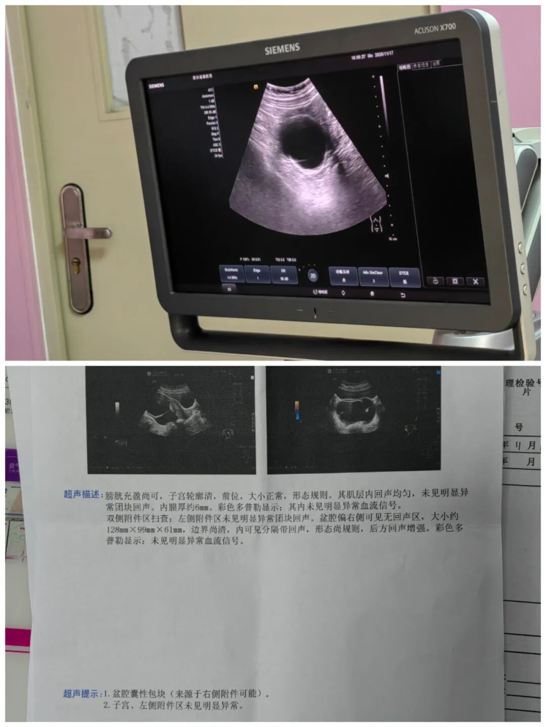 【福德妇科】微创穿刺化解卵巢囊肿困扰
