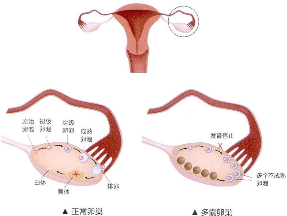 【福德妇科】月经乱？长痘？难孕？警惕多囊！中药调理助您找回身体平衡