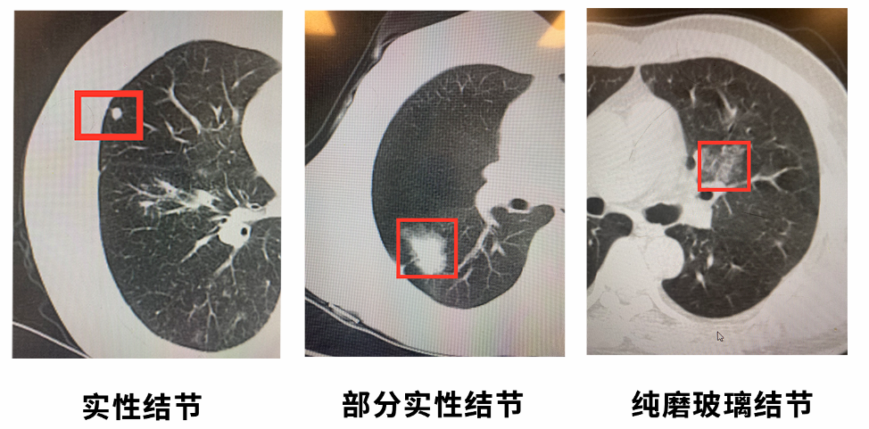 【福德外科】体检查出肺磨玻璃结节怎么办？