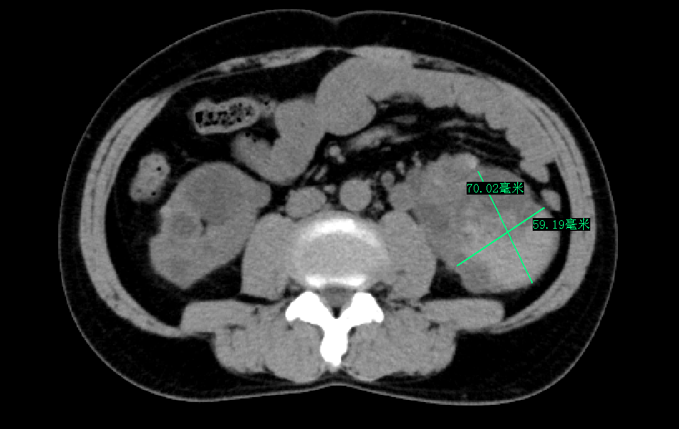 莆田福德医院泌尿肾病科收获锦旗