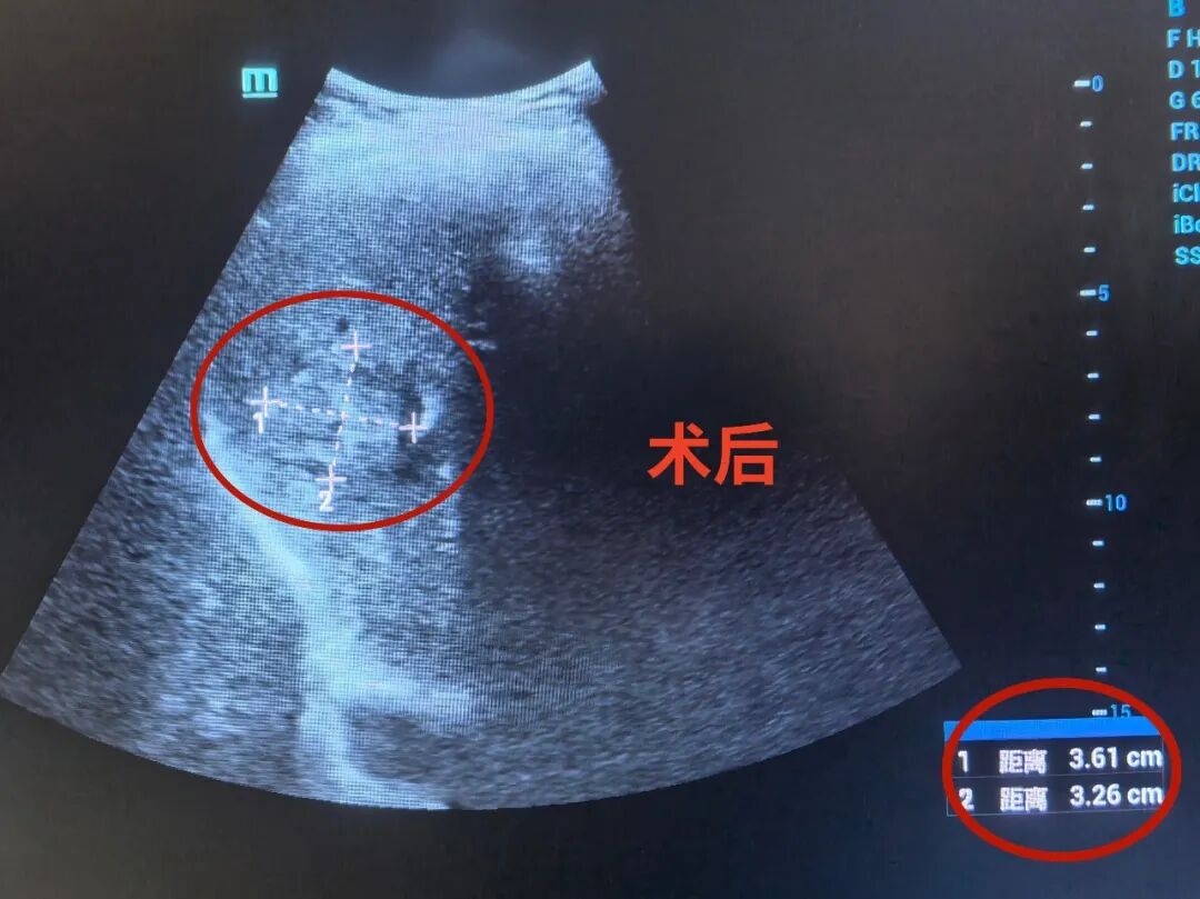 【超声介入】一根细管“穿”破危局！福德医院多学科协作精准守护生命