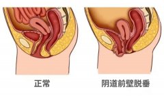 【福德妇科】阴道脱垂困扰12年,福德医院妇科助其重获健康